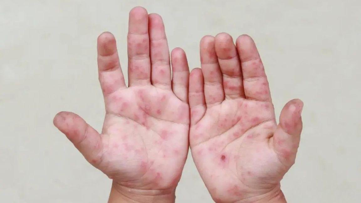 Cierran cinco grupos en preescolares de Piedras Negras por brotes del virus Coxsackie